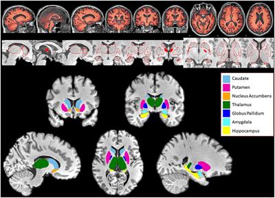 Volumetric Reductions of Subcortical Structures and Their Localizations in Alcohol-Dependent Patients